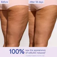 Before and after comparison of cellulite reduction on thighs over 56 days.