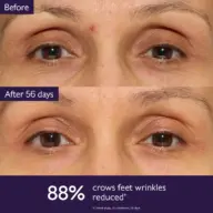 Before and after images of eyes, showing reduced crow's feet wrinkles. 88% reduction noted.
