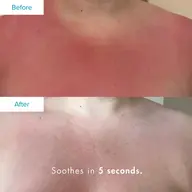 Red skin before and calmer skin after using product. Text: "Soothes in 5 seconds.