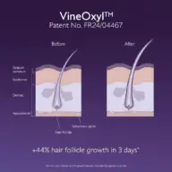 Diagram of hair follicle growth before and after using VineOxyl. Patent No. FR24/04467.
