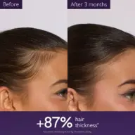 Side-by-side comparison of hair thickness before and after 3 months, showing 87% increase.