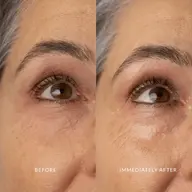 Close-up of an eye before and after skincare treatment, showing reduced wrinkles.