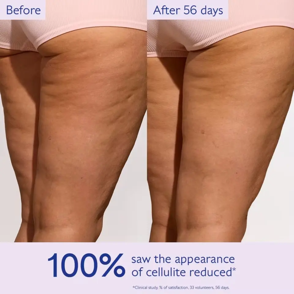 Before and after comparison of cellulite reduction on thighs over 56 days.