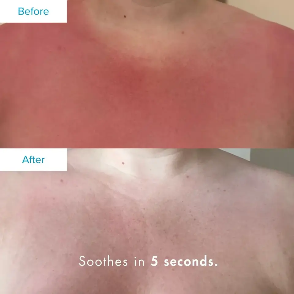 Red skin before and calmer skin after using product. Text: "Soothes in 5 seconds.