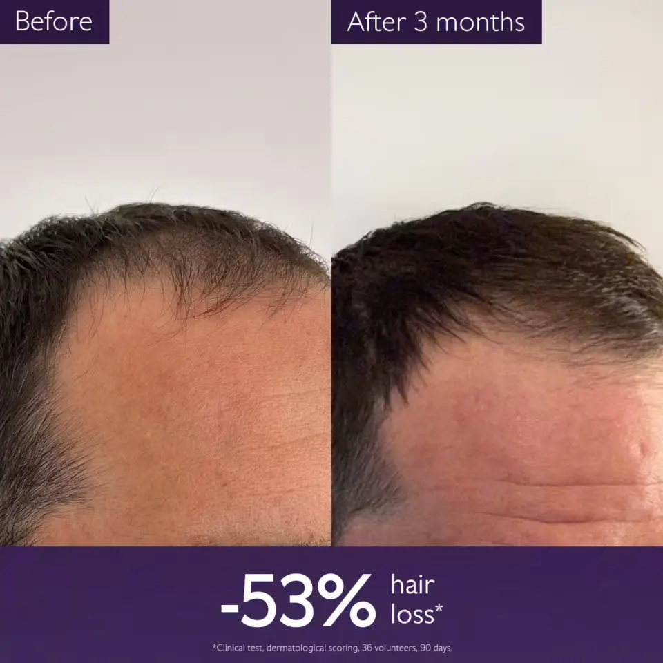 Before and after hair growth comparison over 3 months, showing 53% hair loss reduction.