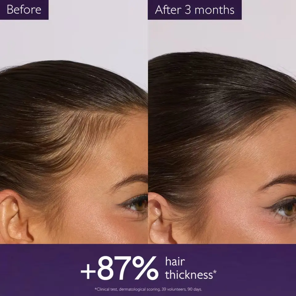 Side-by-side comparison of hair thickness before and after 3 months, showing 87% increase.