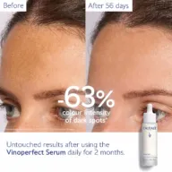 Before and after comparison of dark spots reduced by 63% using Vinoperfect Serum for 56 days.
