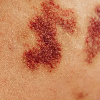 Close-up of a red, irritated skin rash on a person's body.