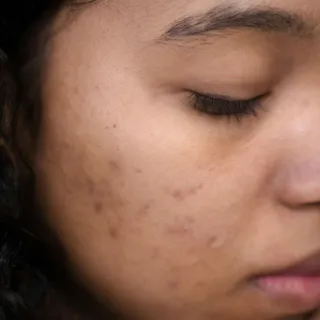 Close-up of a person's face with acne scars and closed eyes.