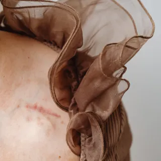Brown ruffled fabric on shoulder with visible scar on skin.