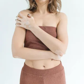 Person with vitiligo wearing a brown strapless top and trousers, arms crossed over chest.